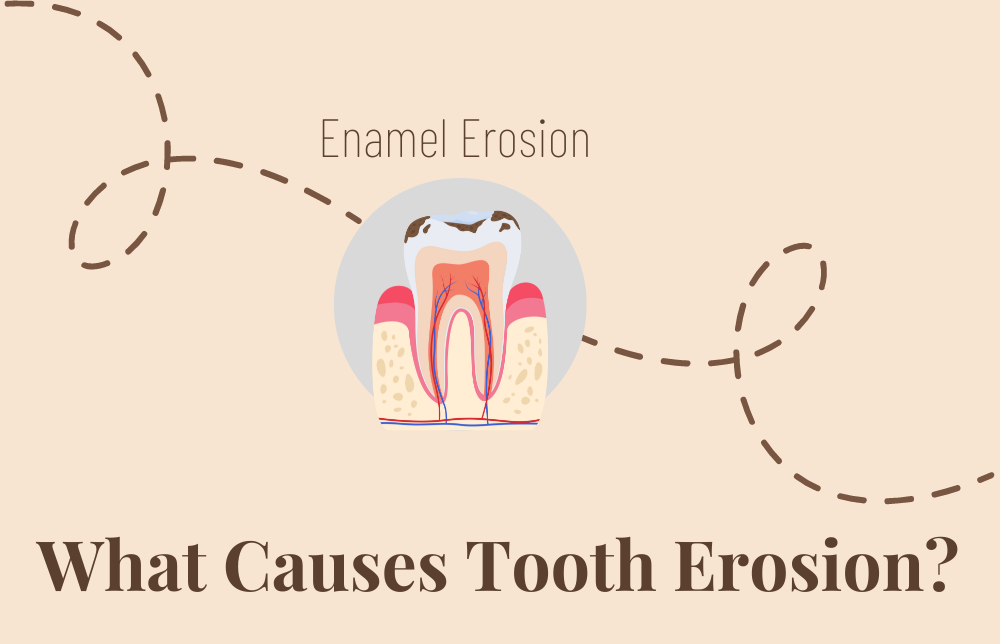 What Causes Tooth Erosion? Image